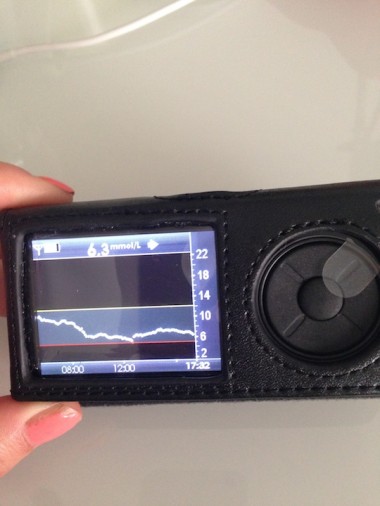 CGM – should you get one?